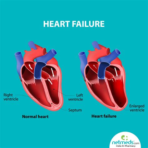 lv dysfunction treatment|severe left ventricular dysfunction treatment.